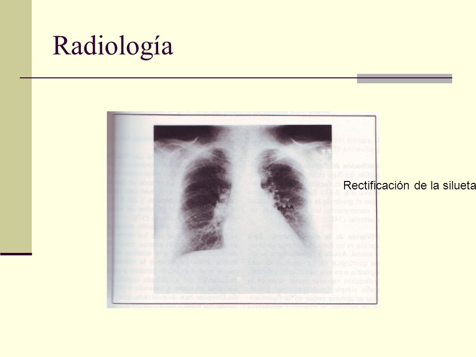 Radiología Rectificación de la silueta