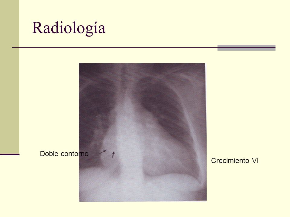 Radiología Doble contorno Crecimiento VI