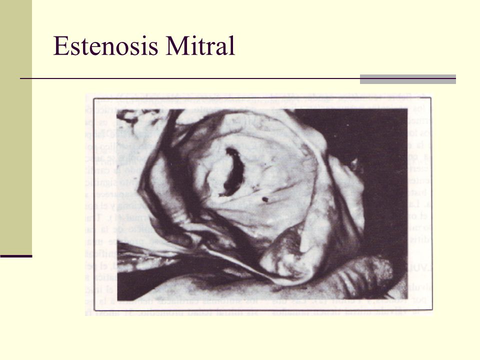 Estenosis Mitral