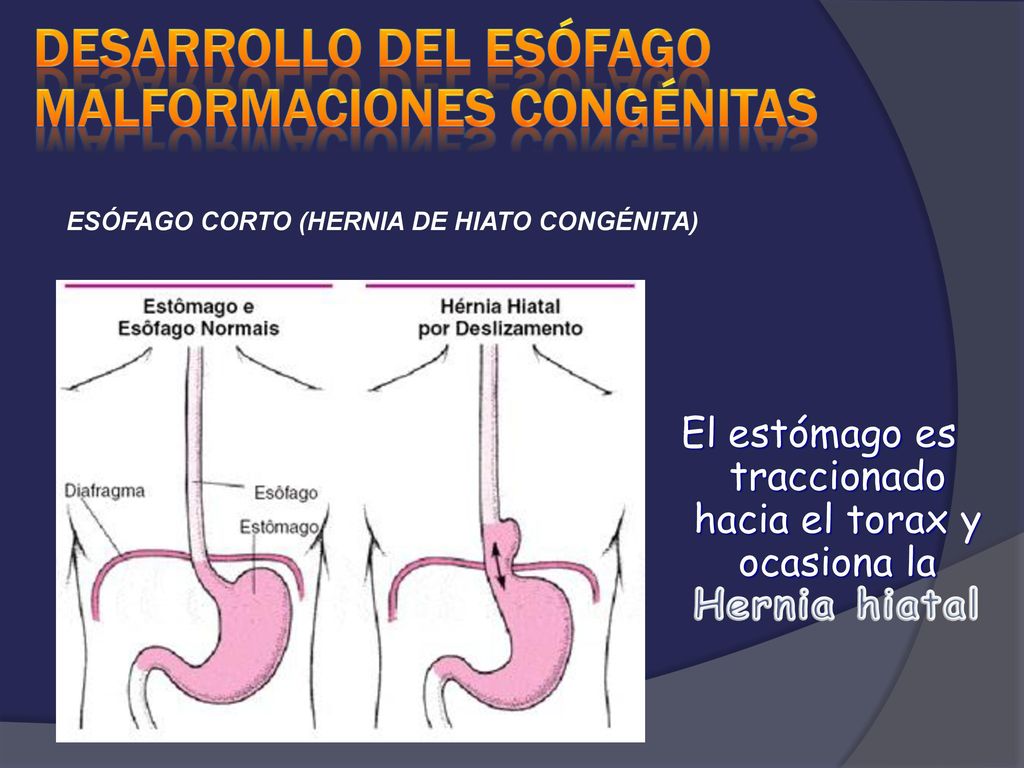 El estómago es traccionado hacia el torax y ocasiona la Hernia hiatal