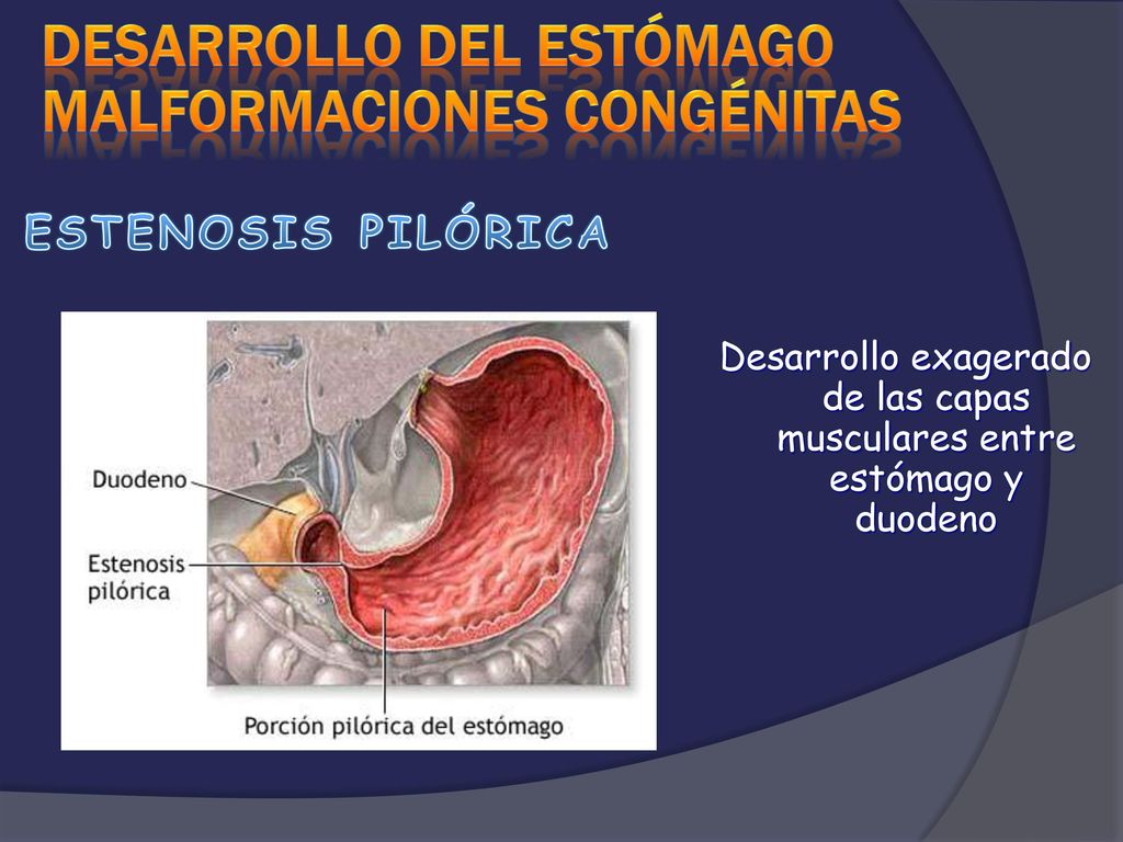 Desarrollo exagerado de las capas musculares entre estómago y duodeno