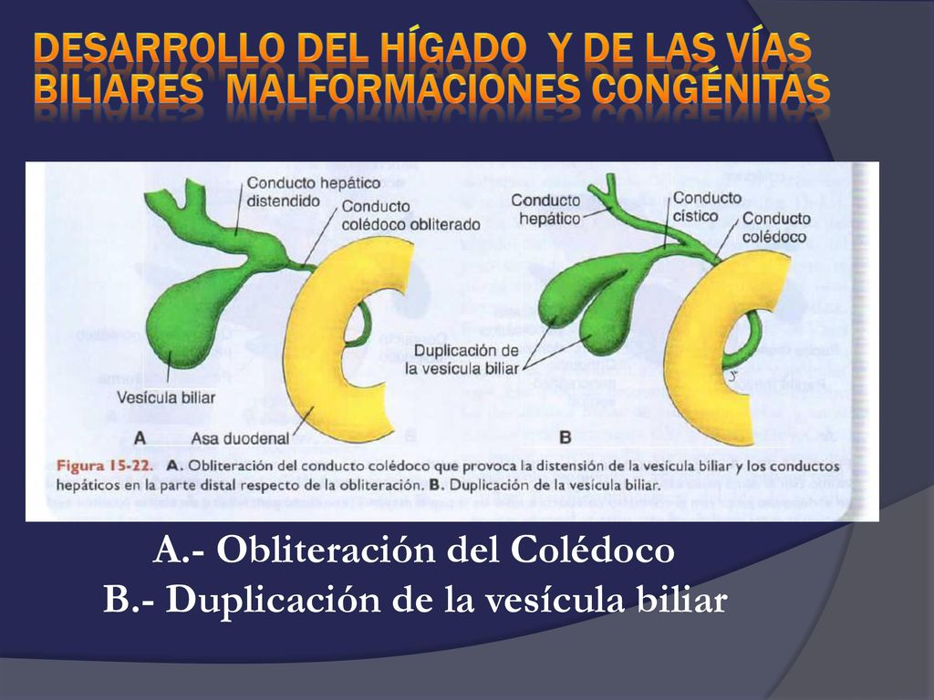 A.- Obliteración del Colédoco B.- Duplicación de la vesícula biliar