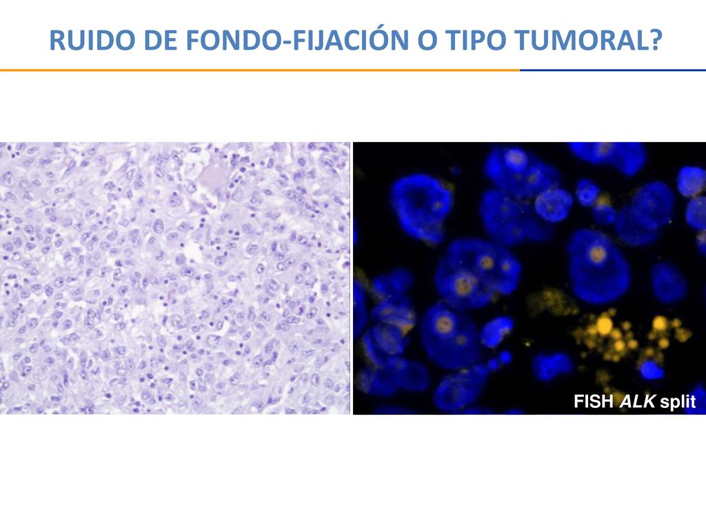 RUIDO DE FONDO-FIJACIÓN O TIPO TUMORAL