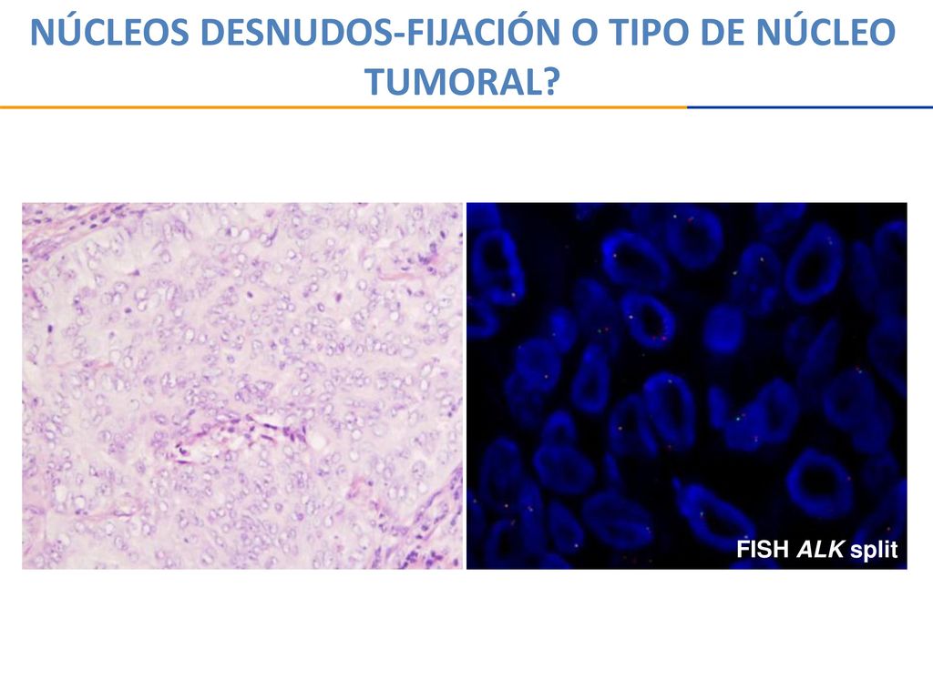 NÚCLEOS DESNUDOS-FIJACIÓN O TIPO DE NÚCLEO TUMORAL