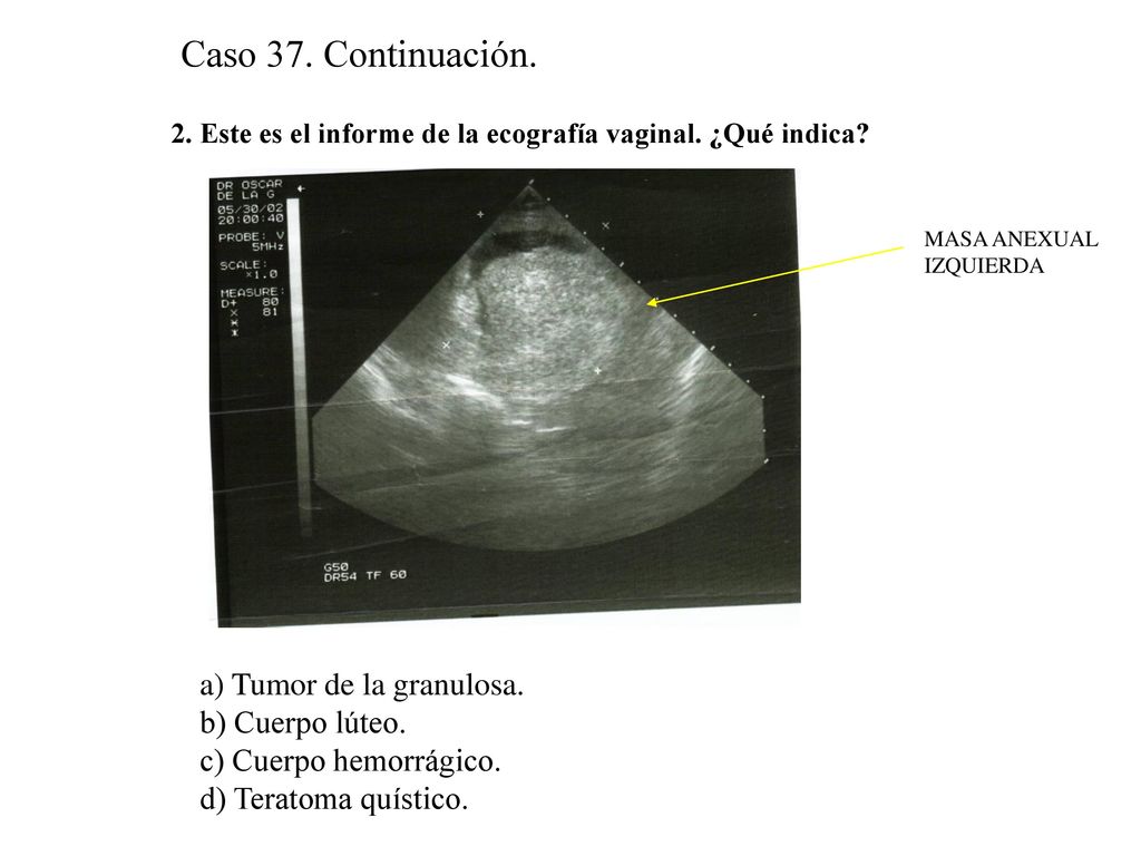 Caso 37. Continuación. a) Tumor de la granulosa. b) Cuerpo lúteo.