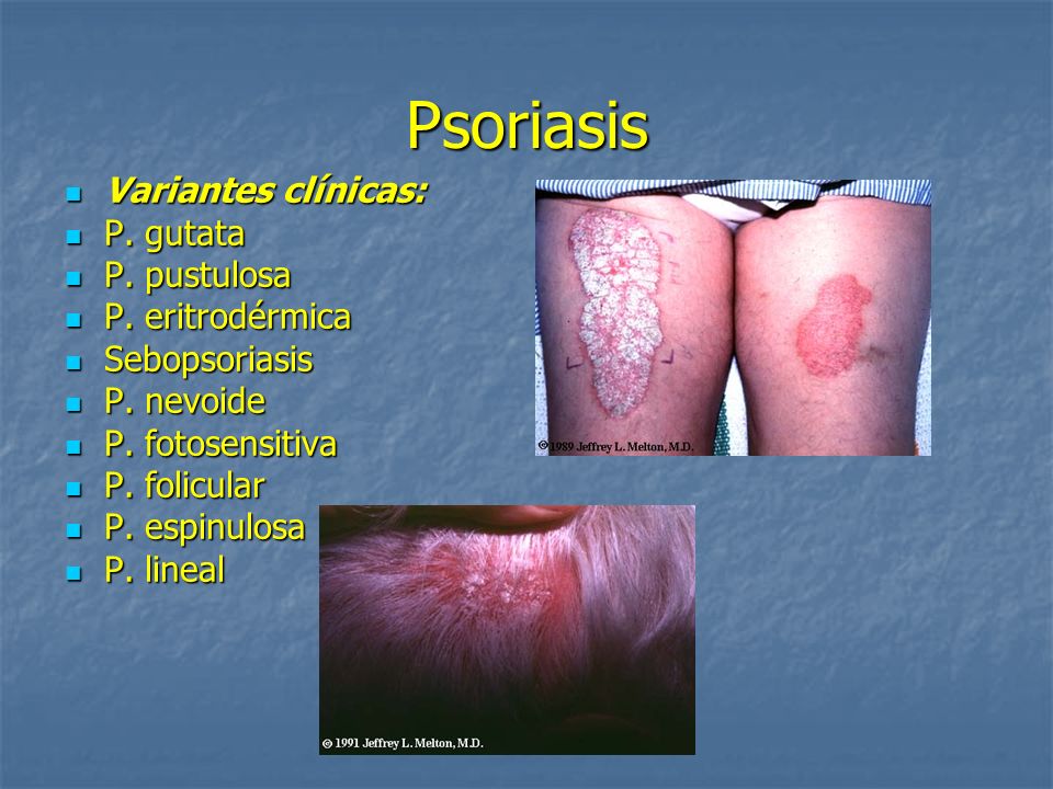 Psoriasis Variantes clínicas: P. gutata P. pustulosa P. eritrodérmica