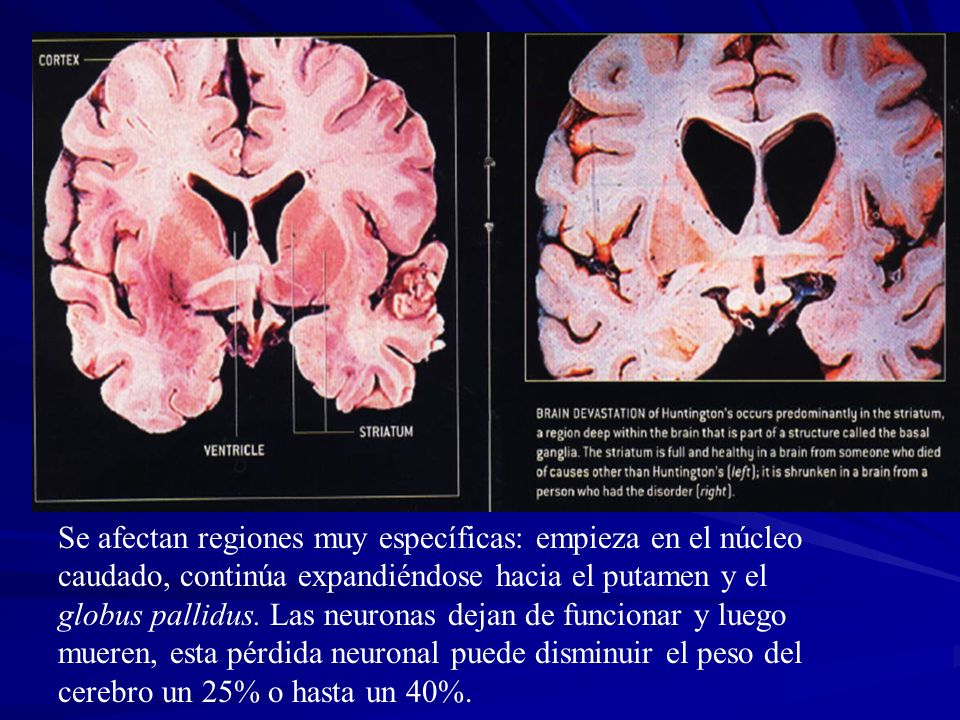 Se afectan regiones muy específicas: empieza en el núcleo caudado, continúa expandiéndose hacia el putamen y el globus pallidus.