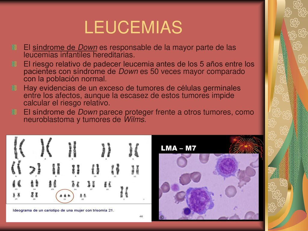 LEUCEMIAS El síndrome de Down es responsable de la mayor parte de las leucemias infantiles hereditarias.