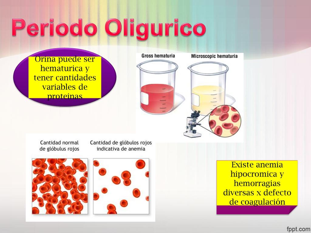 Orina puede ser hematurica y tener cantidades variables de proteinas