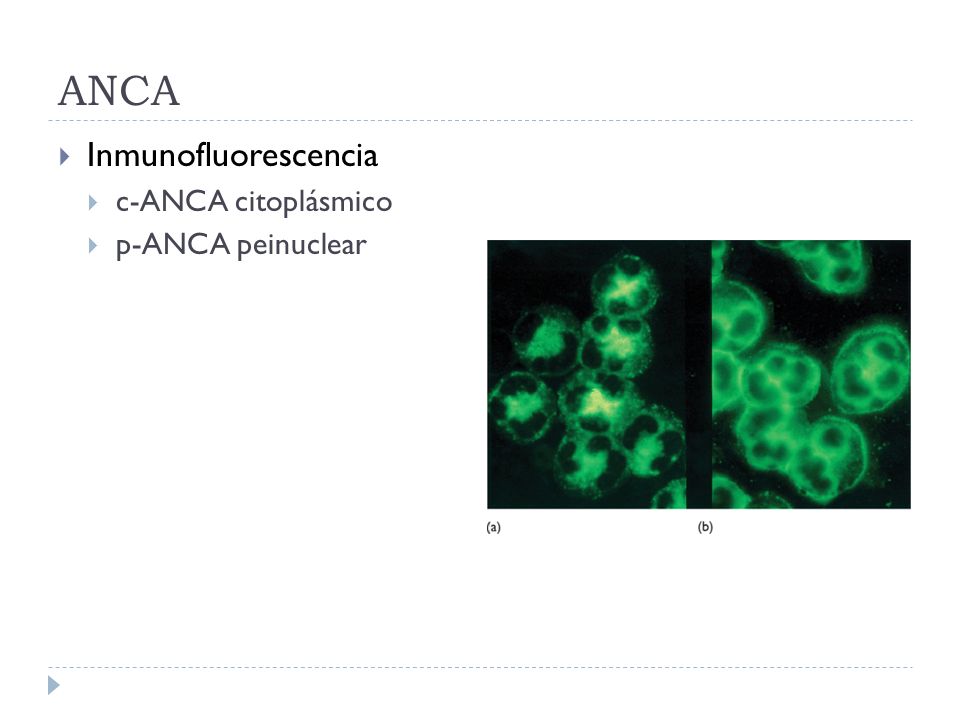 ANCA Inmunofluorescencia c-ANCA citoplásmico p-ANCA peinuclear