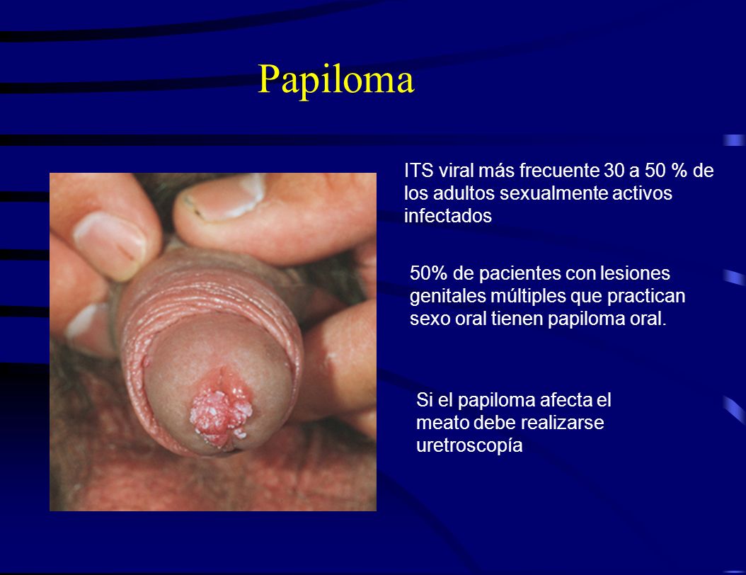Papiloma ITS viral más frecuente 30 a 50 % de los adultos sexualmente activos infectados.