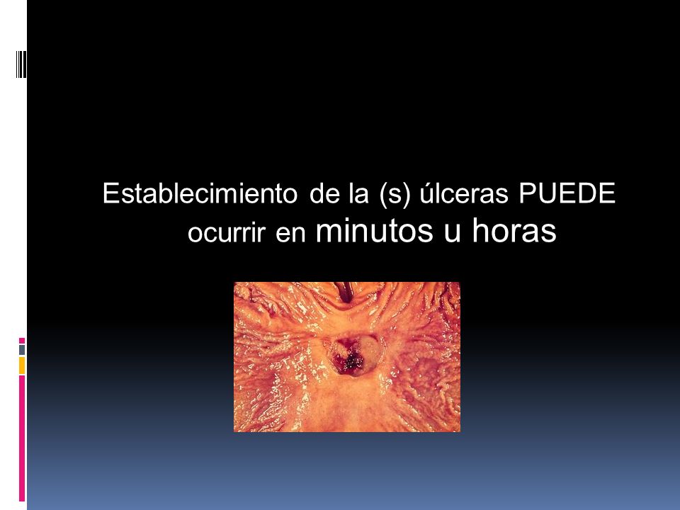 Establecimiento de la (s) úlceras PUEDE ocurrir en minutos u horas