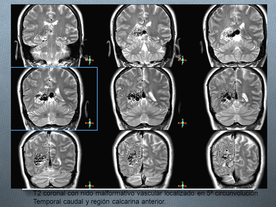 T2 coronal con nido malformativo vascular localizado en 5ª circunvolución