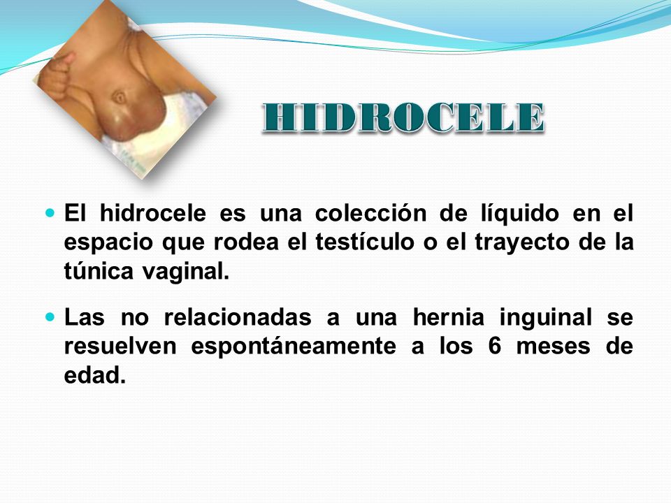 HIDROCELE El hidrocele es una colección de líquido en el espacio que rodea el testículo o el trayecto de la túnica vaginal.
