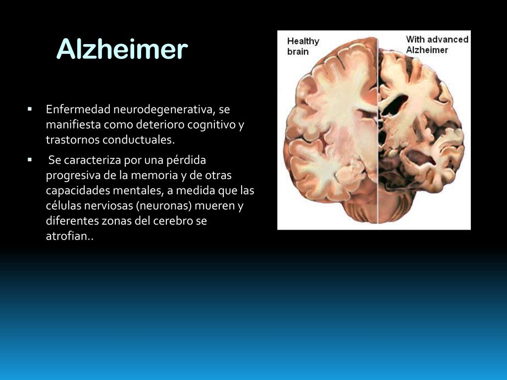 Alzheimer Enfermedad neurodegenerativa, se manifiesta como deterioro cognitivo y trastornos conductuales.
