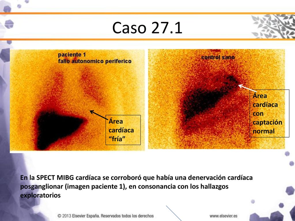 Caso 27.1 Área cardíaca con captación normal Área cardíaca fría