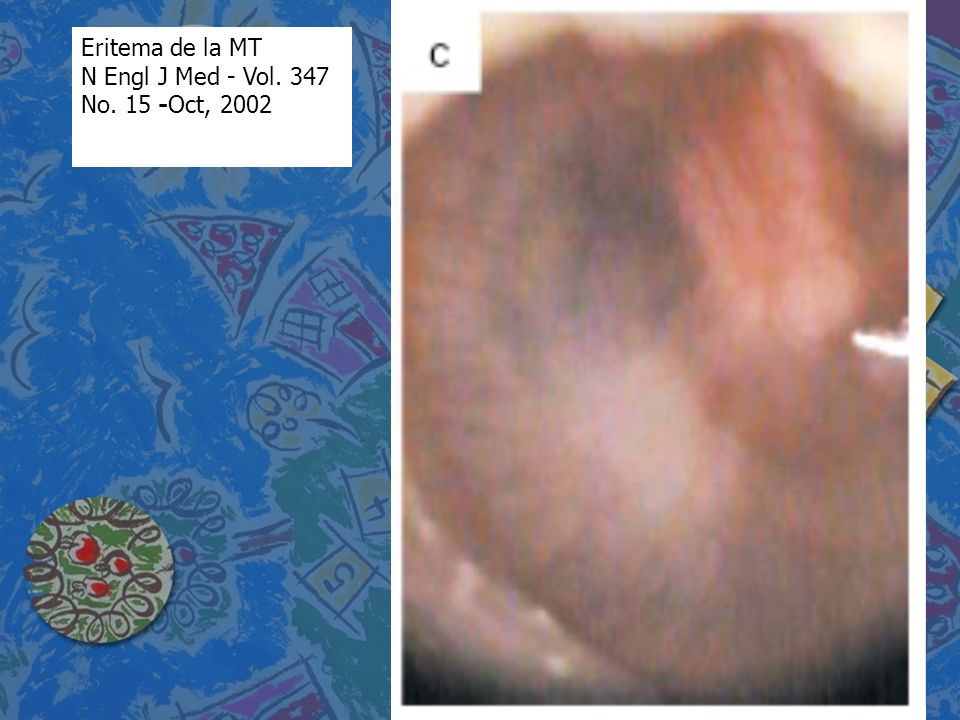 Eritema de la MT N Engl J Med - Vol. 347 No. 15 -Oct, 2002