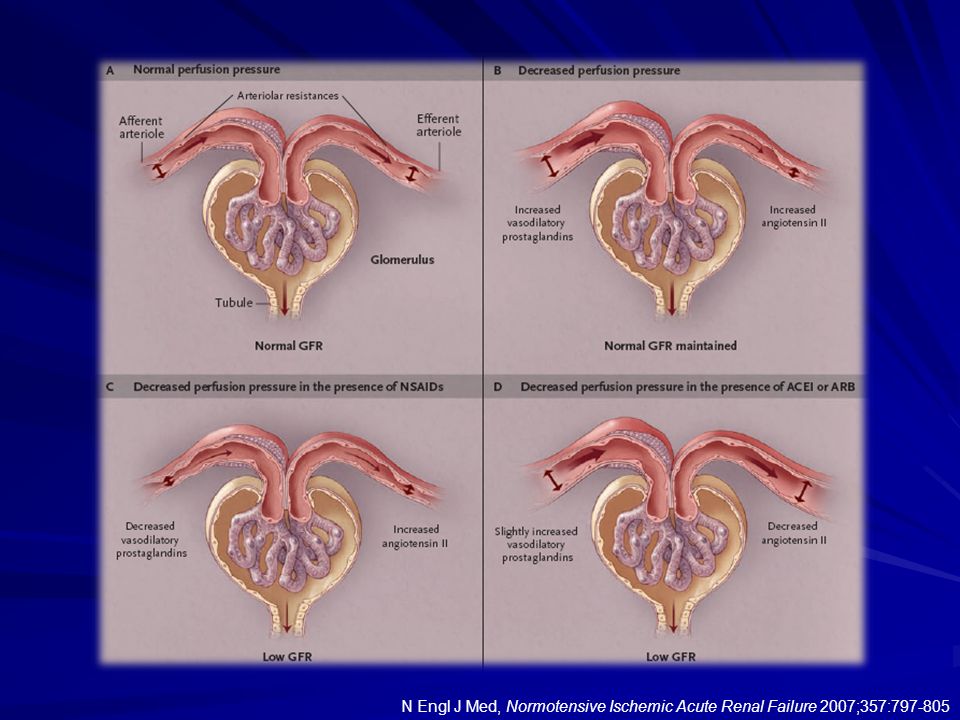 N Engl J Med, Normotensive Ischemic Acute Renal Failure 2007;357: