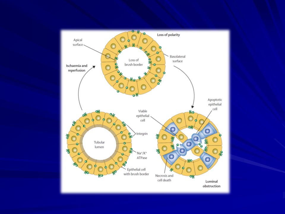 Figure 3: Tubular changes in the pathophysiology of ischaemic acute tubular necrosis