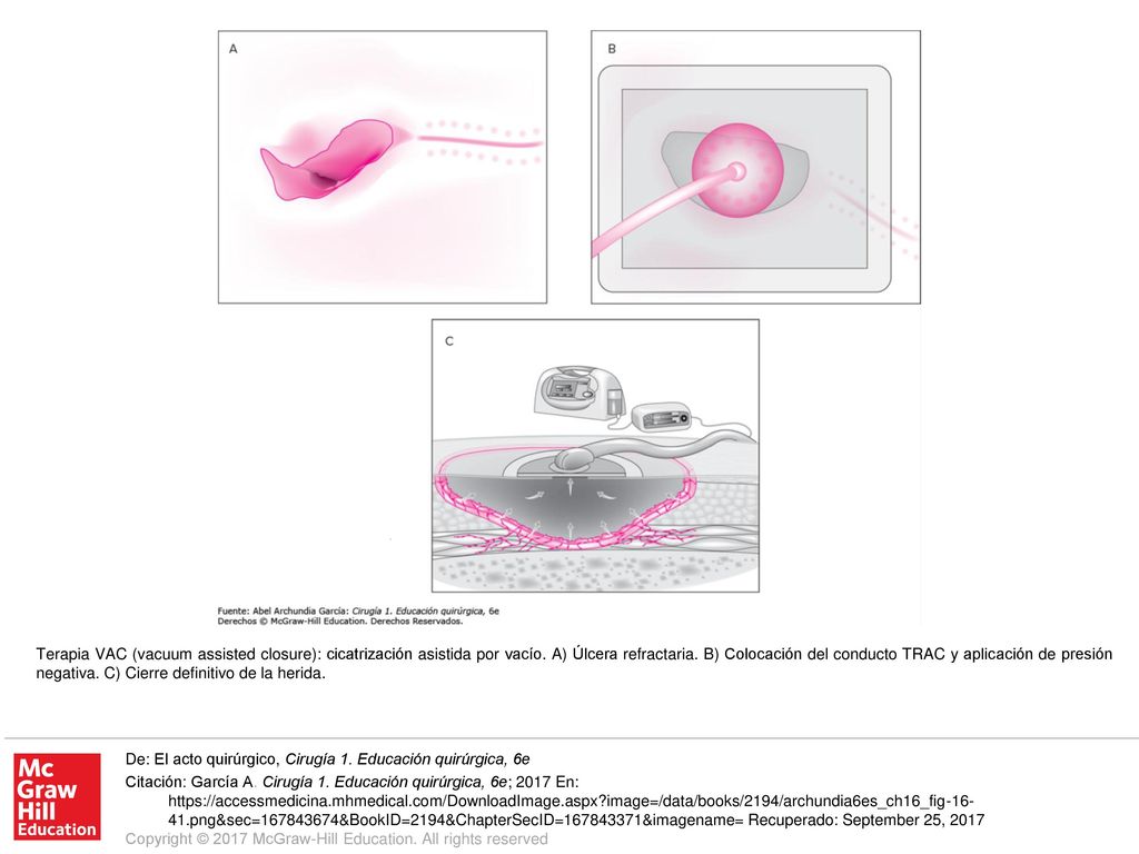 Terapia VAC (vacuum assisted closure): cicatrización asistida por vacío. A) Úlcera refractaria. B) Colocación del conducto TRAC y aplicación de presión negativa. C) Cierre definitivo de la herida.