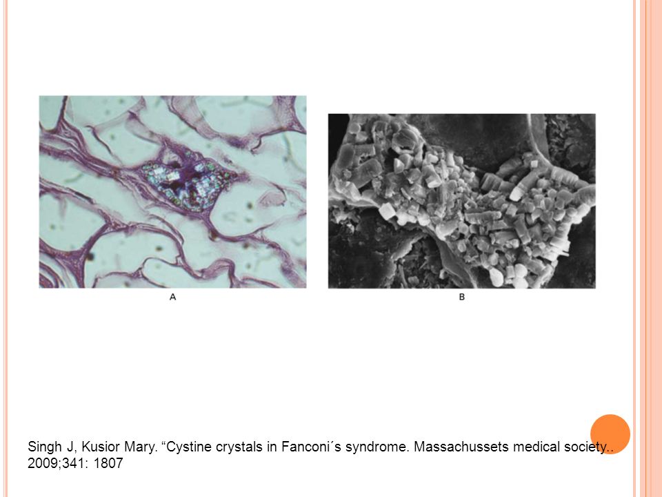Singh J, Kusior Mary. Cystine crystals in Fanconi´s syndrome