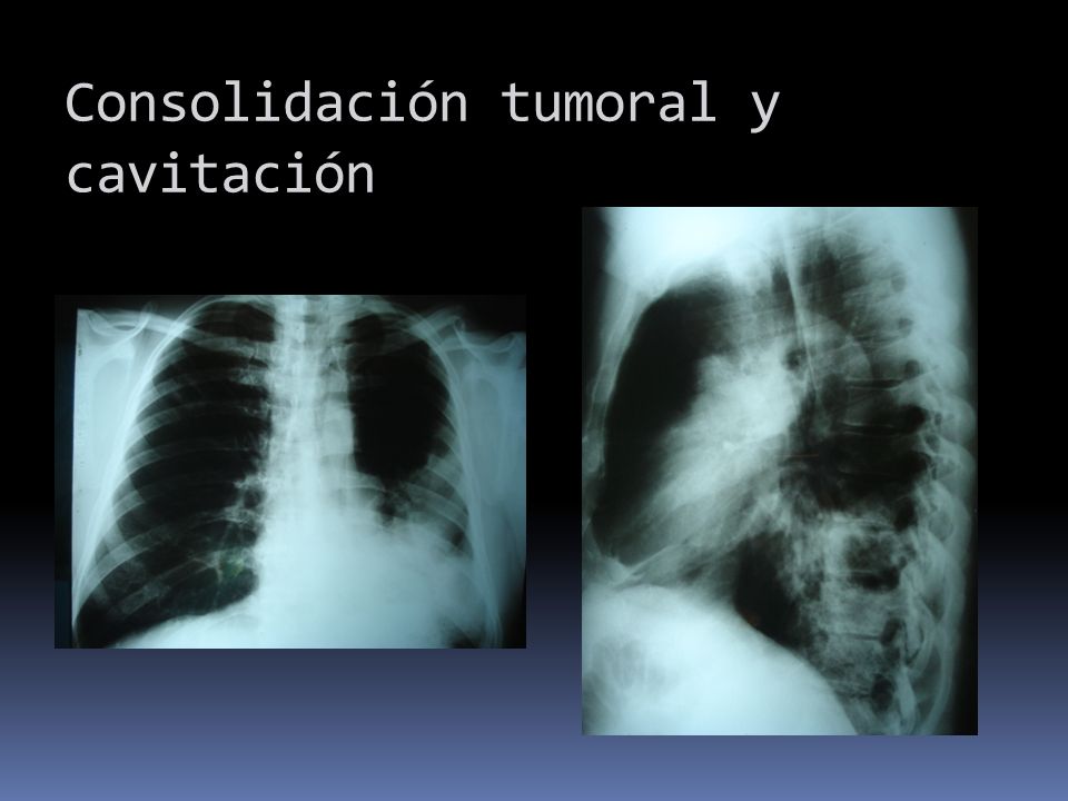 Consolidación tumoral y cavitación