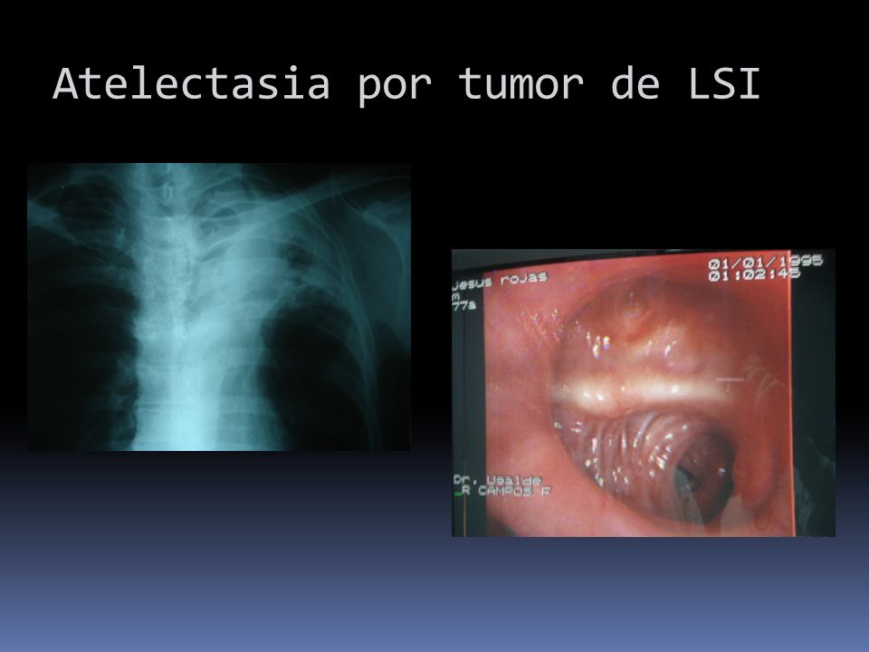 Atelectasia por tumor de LSI