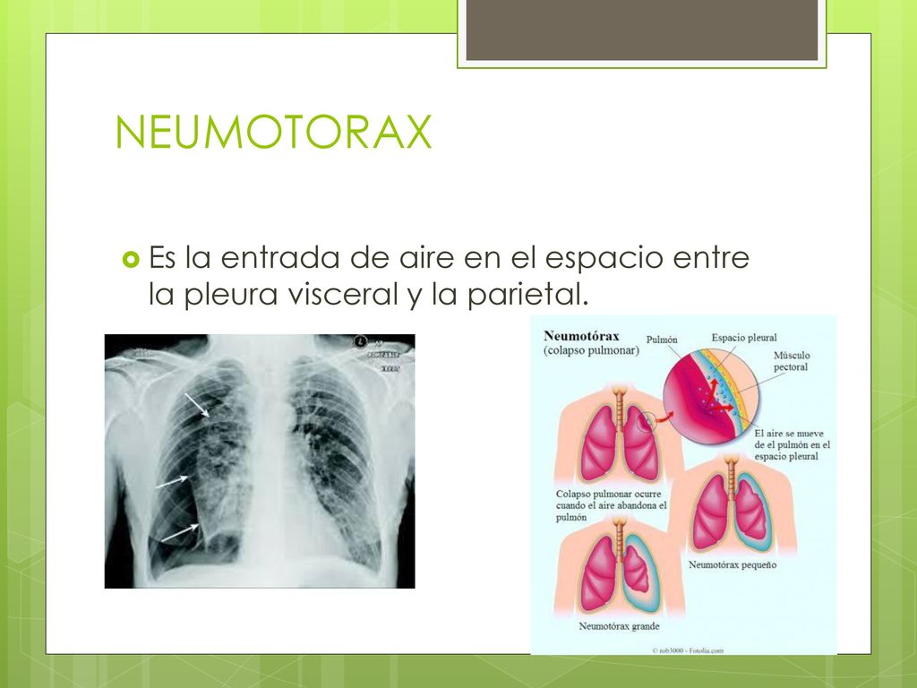 NEUMOTORAX Es la entrada de aire en el espacio entre la pleura visceral y la parietal.