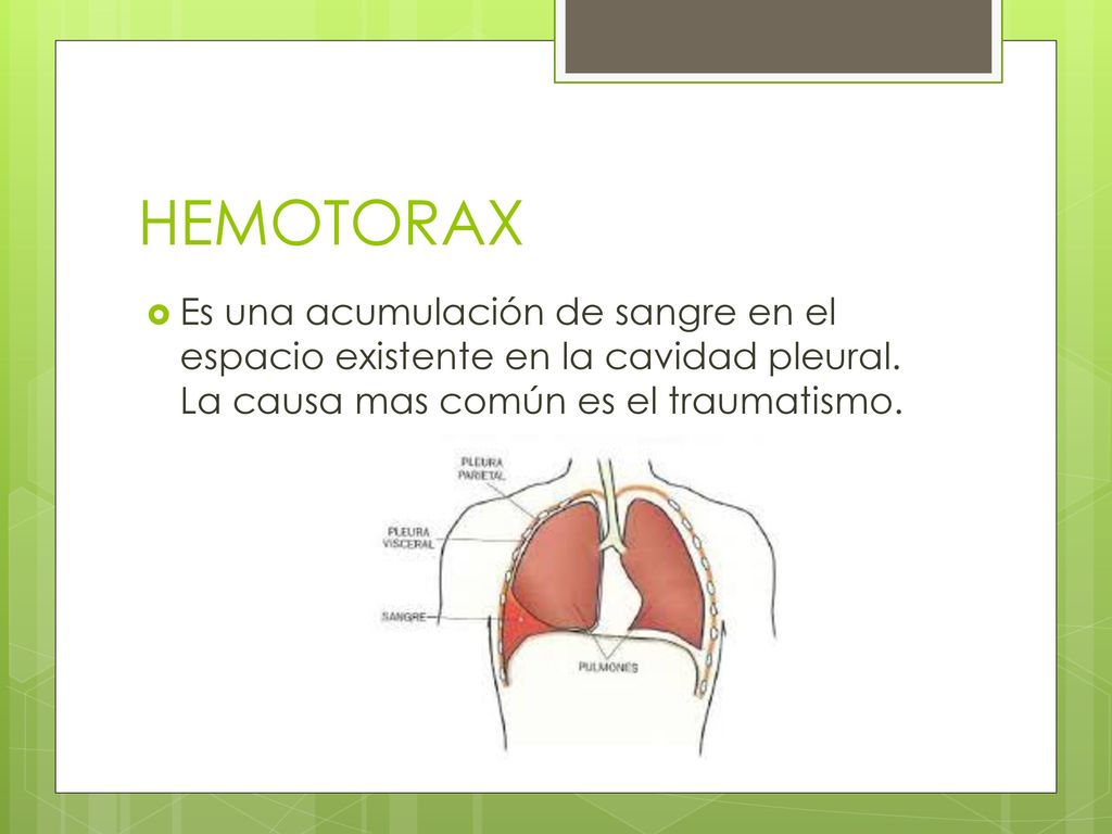 HEMOTORAX Es una acumulación de sangre en el espacio existente en la cavidad pleural.