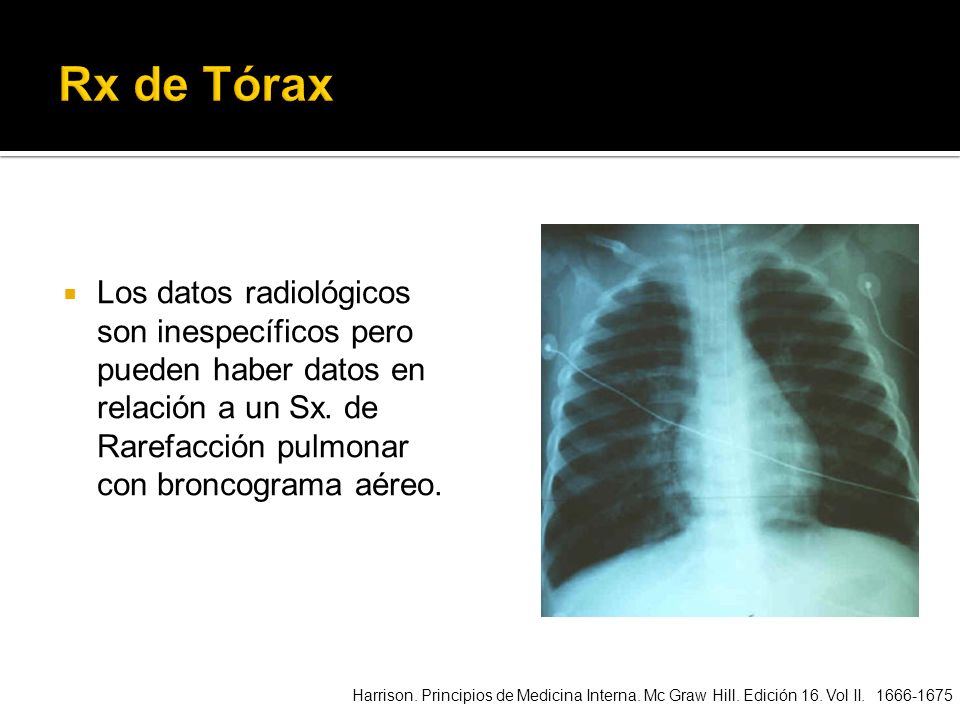 Rx de Tórax Los datos radiológicos son inespecíficos pero pueden haber datos en relación a un Sx. de Rarefacción pulmonar con broncograma aéreo.