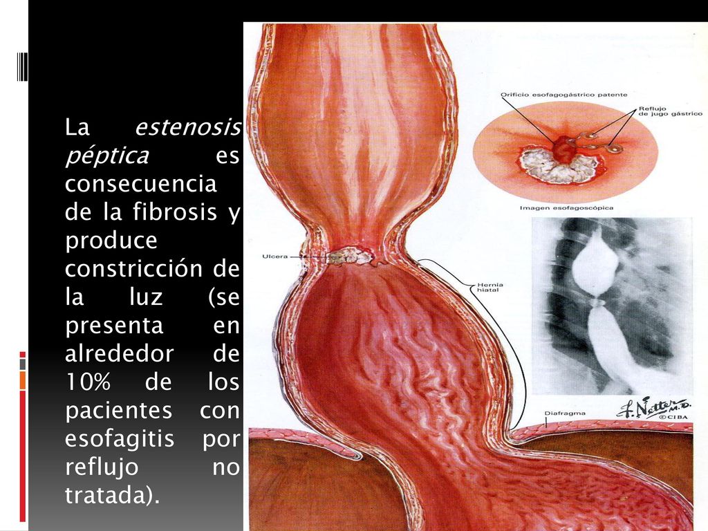 La estenosis péptica es consecuencia de la fibrosis y produce constricción de la luz (se presenta en alrededor de 10% de los pacientes con esofagitis por reflujo no tratada).