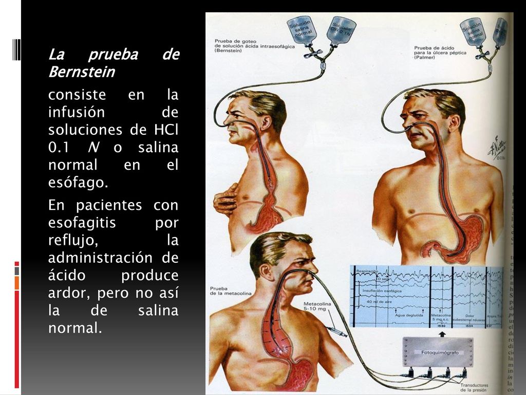 La prueba de Bernstein consiste en la infusión de soluciones de HCl 0.1 N o salina normal en el esófago.
