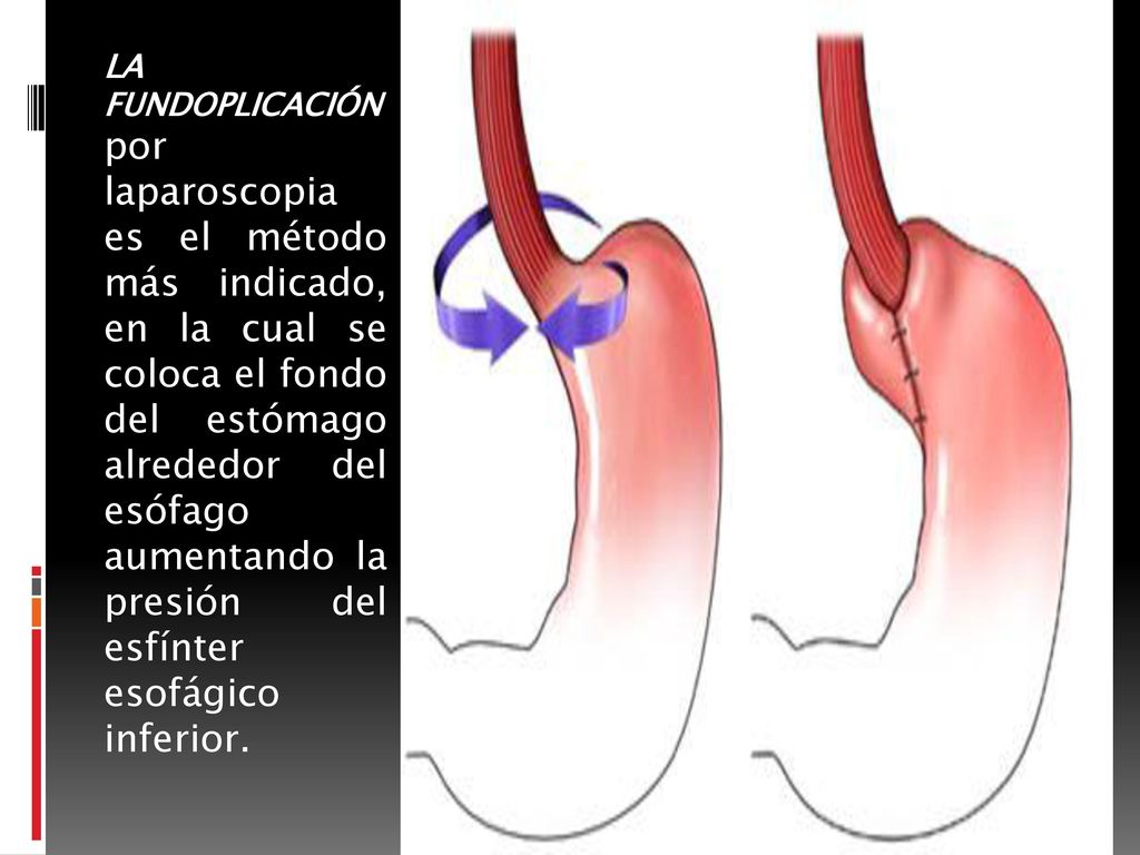 LA FUNDOPLICACIÓN por laparoscopia es el método más indicado, en la cual se coloca el fondo del estómago alrededor del esófago aumentando la presión del esfínter esofágico inferior.