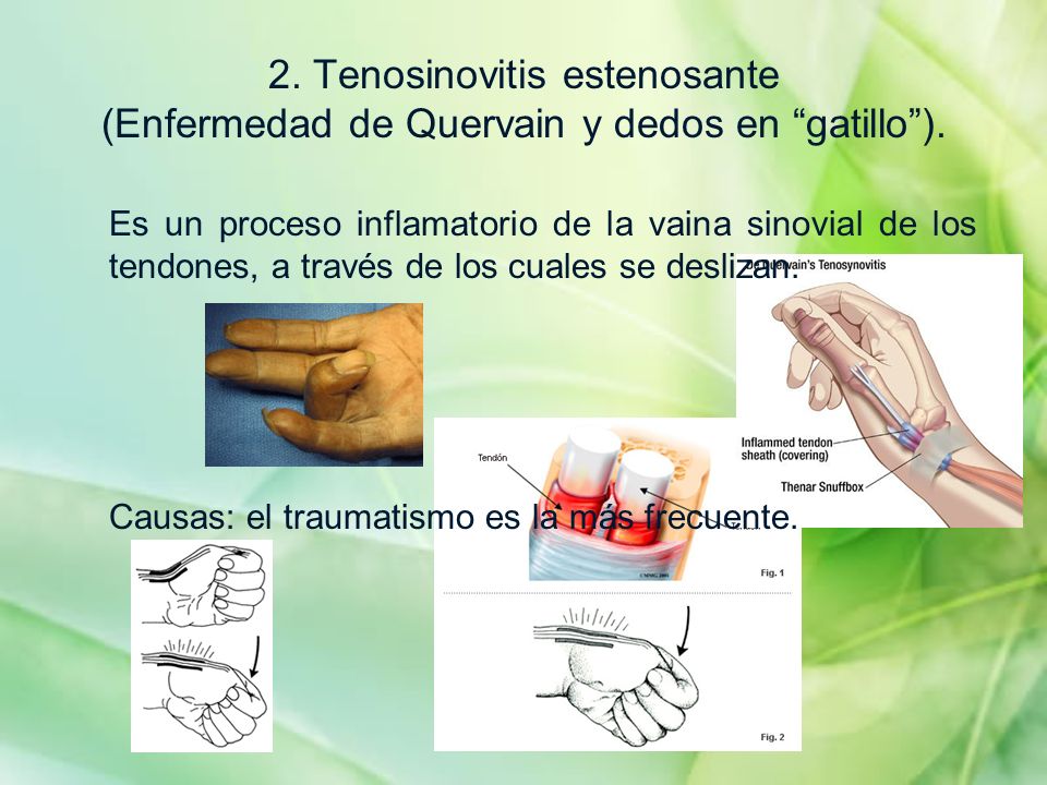 2. Tenosinovitis estenosante (Enfermedad de Quervain y dedos en gatillo ).
