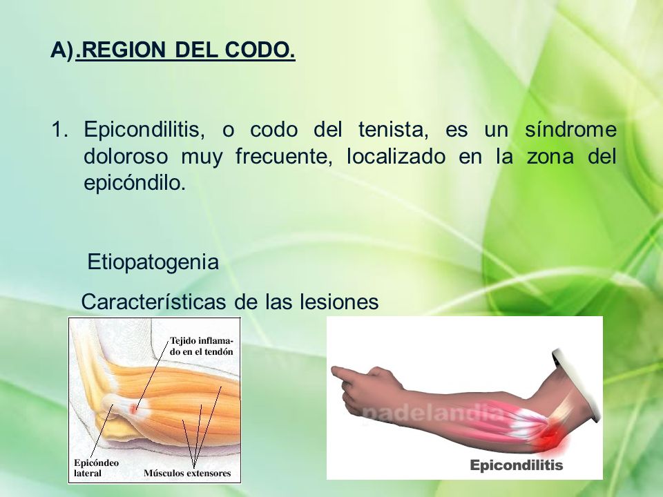 .REGION DEL CODO. Epicondilitis, o codo del tenista, es un síndrome doloroso muy frecuente, localizado en la zona del epicóndilo.