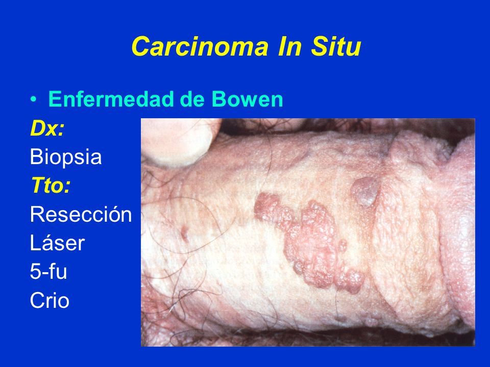 Carcinoma In Situ Enfermedad de Bowen Dx: Biopsia Tto: Resección Láser