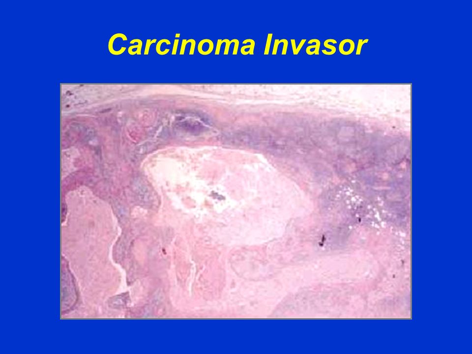 Carcinoma Invasor