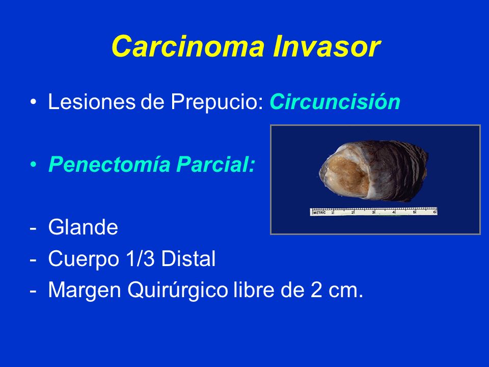 Carcinoma Invasor Lesiones de Prepucio: Circuncisión