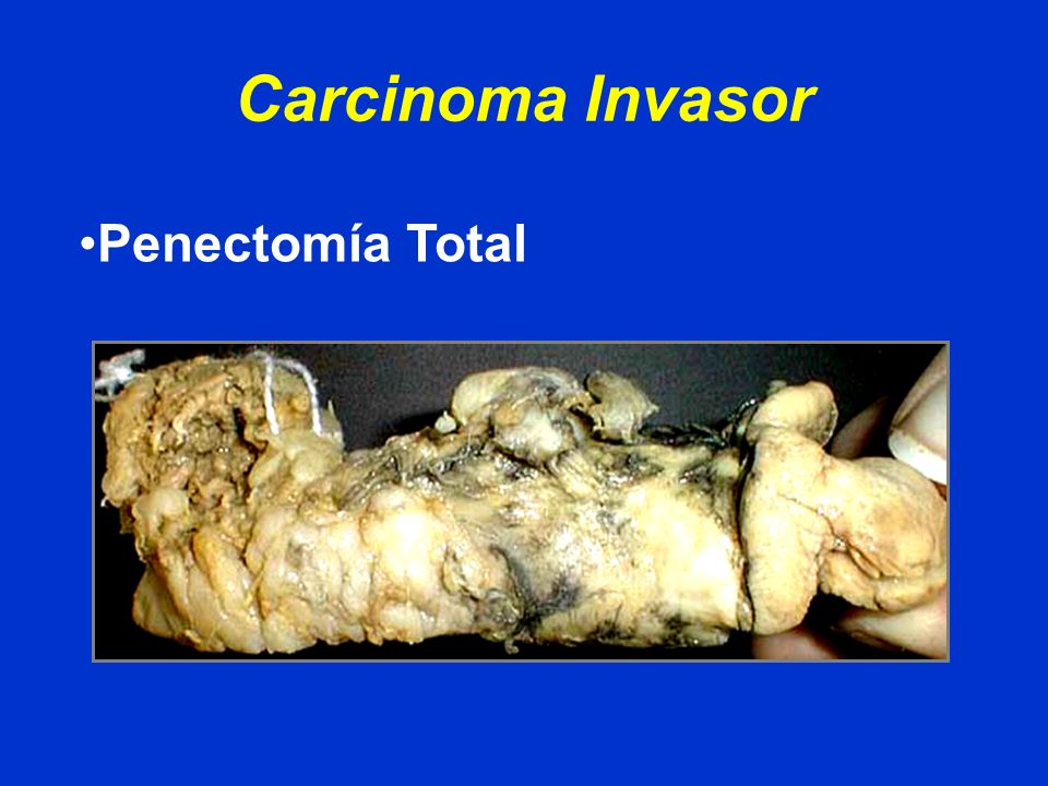 Carcinoma Invasor Penectomía Total