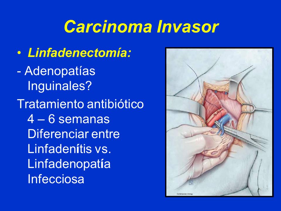 Carcinoma Invasor Linfadenectomía: - Adenopatías Inguinales