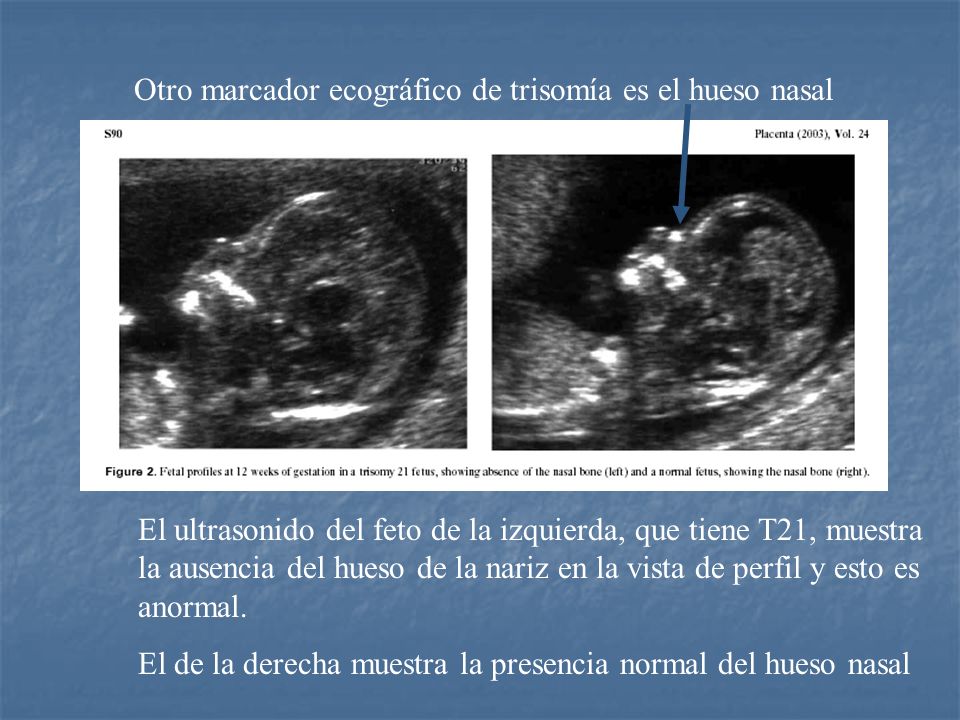 Otro marcador ecográfico de trisomía es el hueso nasal