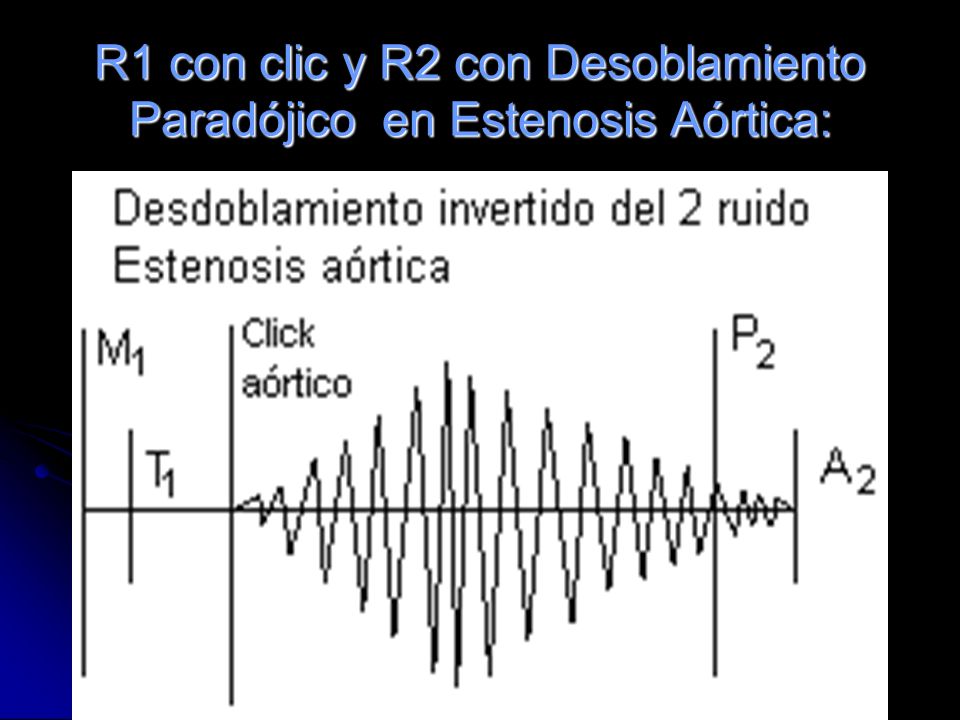 R1 con clic y R2 con Desoblamiento Paradójico en Estenosis Aórtica: