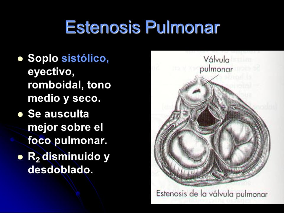 Estenosis Pulmonar Soplo sistólico, eyectivo, romboidal, tono medio y seco. Se ausculta mejor sobre el foco pulmonar.