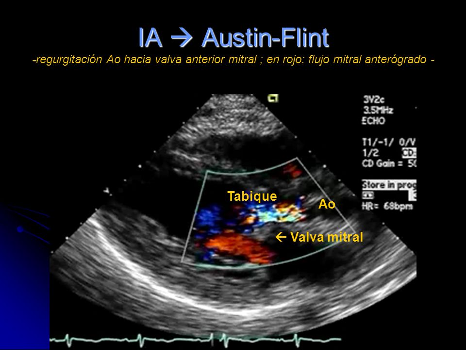 IA  Austin-Flint -regurgitación Ao hacia valva anterior mitral ; en rojo: flujo mitral anterógrado -