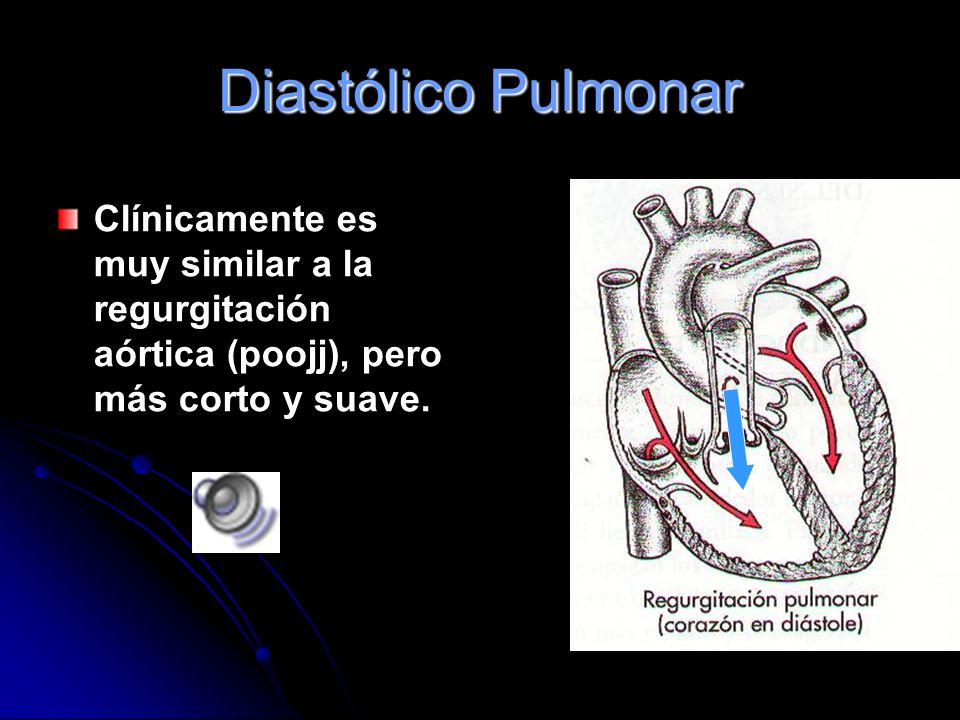 Diastólico Pulmonar Clínicamente es muy similar a la regurgitación aórtica (poojj), pero más corto y suave.