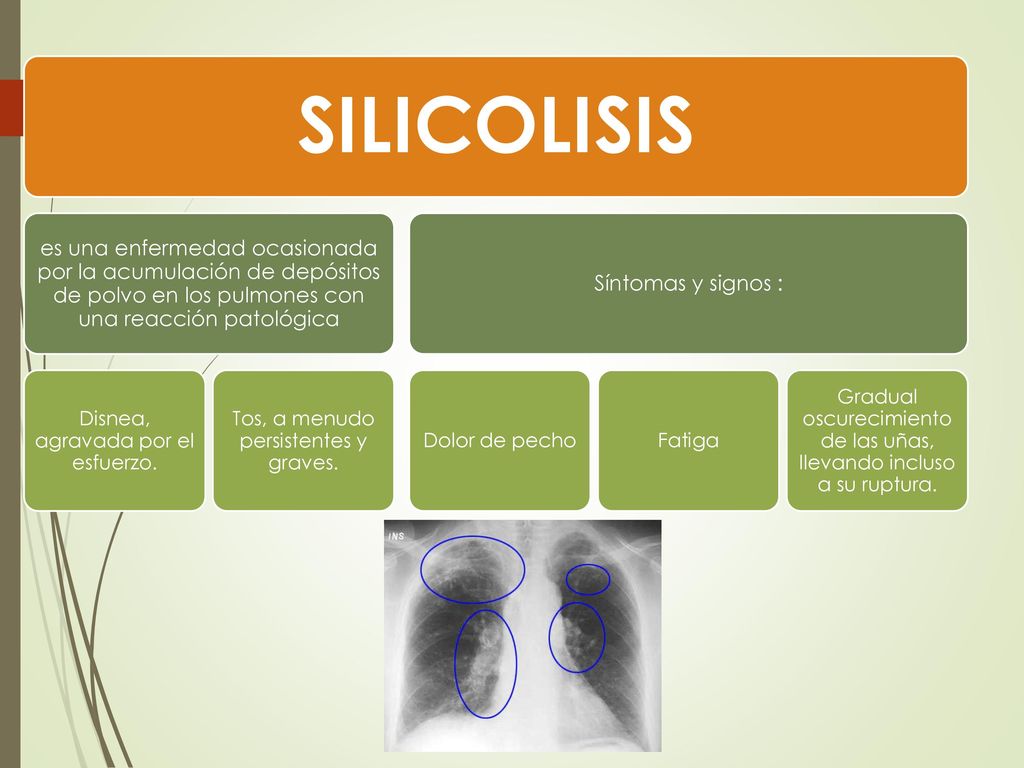 SILICOLISIS es una enfermedad ocasionada por la acumulación de depósitos de polvo en los pulmones con una reacción patológica.