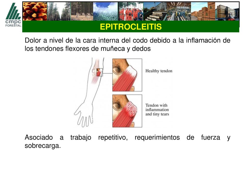 EPITROCLEITIS Dolor a nivel de la cara interna del codo debido a la inflamación de los tendones flexores de muñeca y dedos.