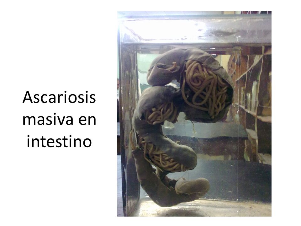Ascariosis masiva en intestino