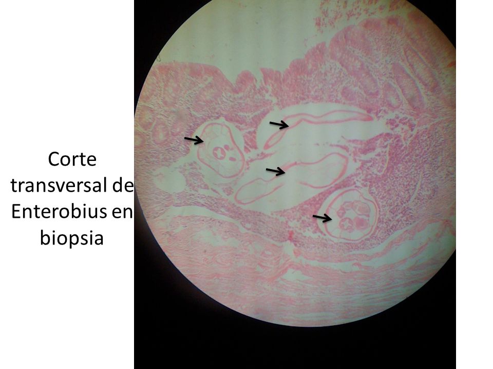 Corte transversal de Enterobius en biopsia