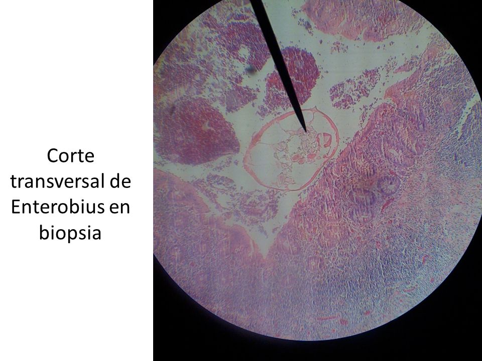 Corte transversal de Enterobius en biopsia